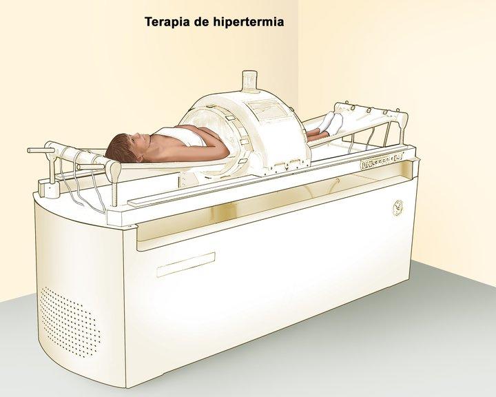 Terapia de hipertermia para tratar el cáncer NCI